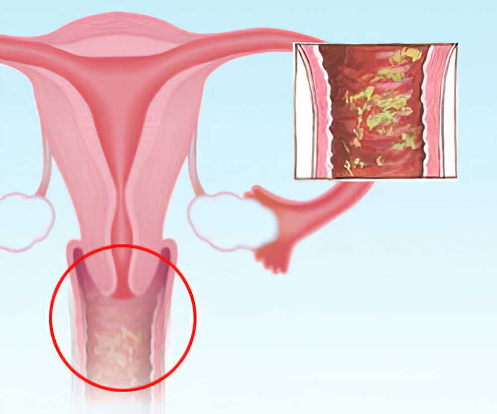 noznica_glivice_okuzba